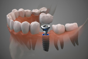 escoger implante dental