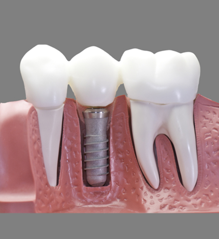 Cómo se pone un diente postizo provisional? - Clínica Dental en