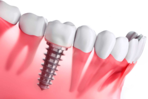 fase quirúrgica de los implantes dentales