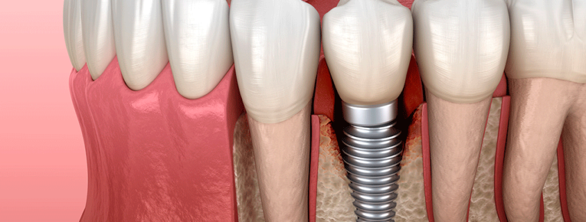 Problemas comunes con implantes dentales