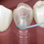 Cuidados de implantes dentales