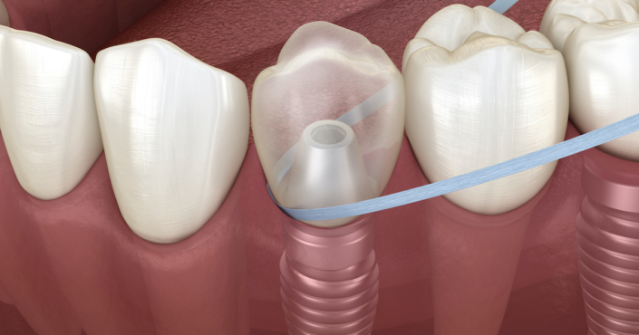 Cuidados de implantes dentales